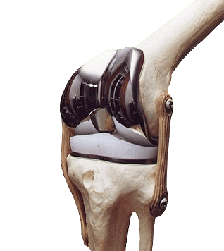 Prótese do joelho